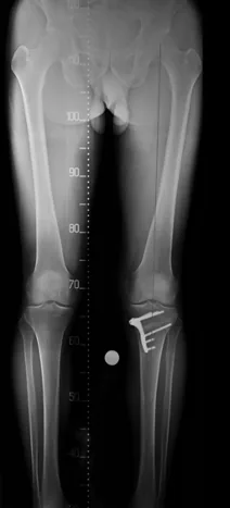Postoperative xray 02